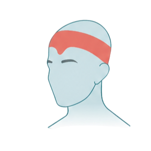Recurring migraine attacks